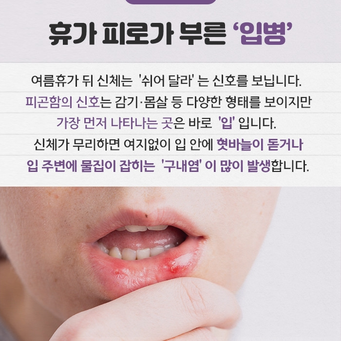 휴가 뒤 찾아온 입병 ‘구내염’ 종류 & 개선법