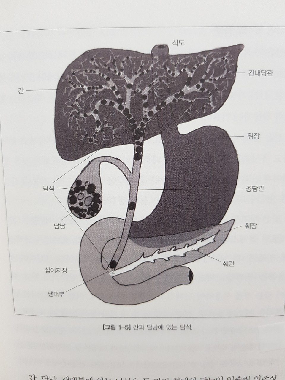 현대인이라면 누구나 가지고 있는 골칫덩이(담석)