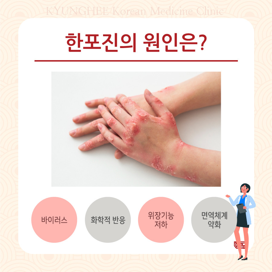 손한포진, 손이 가렵고 수포와 물집, 각질이 생겨요.