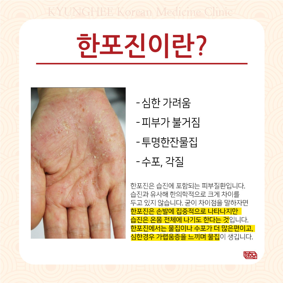 손한포진, 손이 가렵고 수포와 물집, 각질이 생겨요.