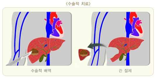 몸살인 줄 알았는데 간에 고름이 생겼어요: 간 농양 8 ywAAAAAAQABAAACAUwAOw==