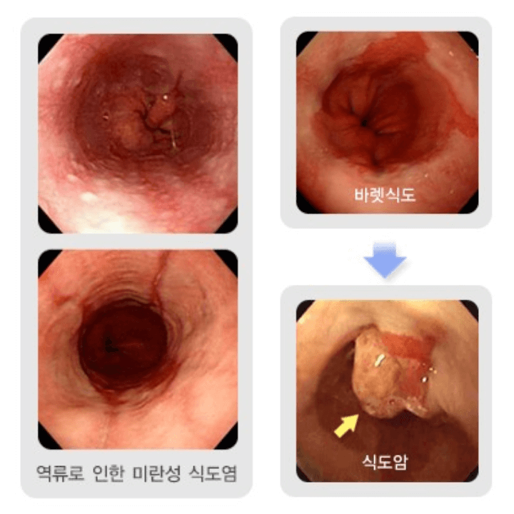 역류성 식도염 : 증상부터 예방까지 2 역류성-식도염-관련-질환