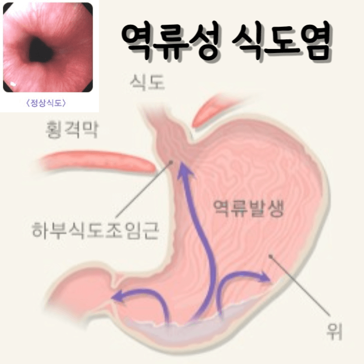 역류성 식도염 : 증상부터 예방까지 1 역류성식도염