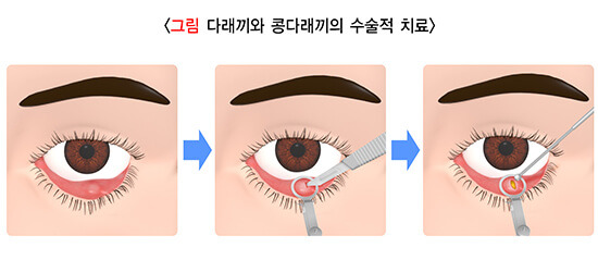 눈꺼풀 분비샘의 염증성 질환: 다래끼와 콩다래끼 4 ywAAAAAAQABAAACAUwAOw==