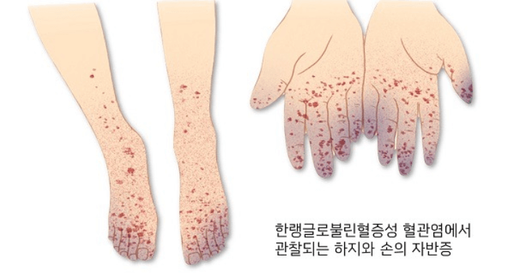 희귀 질환 : 한랭글로불린혈증성 혈관염이란? 2 ywAAAAAAQABAAACAUwAOw==