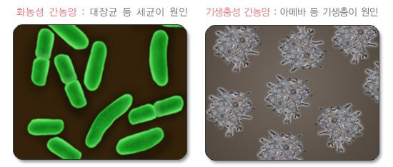 몸살인 줄 알았는데 간에 고름이 생겼어요: 간 농양 2 ywAAAAAAQABAAACAUwAOw==