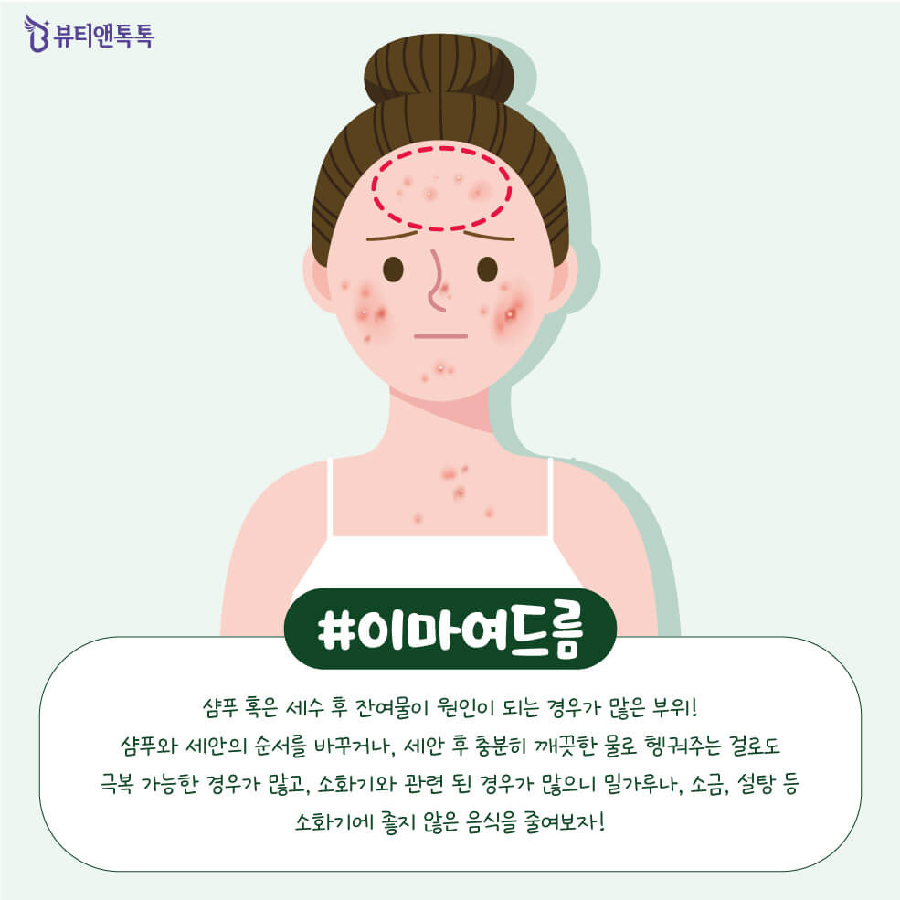 Các phương pháp phòng ngừa mụn trứng cá theo từng vùng da