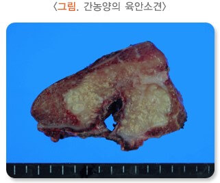 몸살인 줄 알았는데 간에 고름이 생겼어요: 간 농양 5 ywAAAAAAQABAAACAUwAOw==