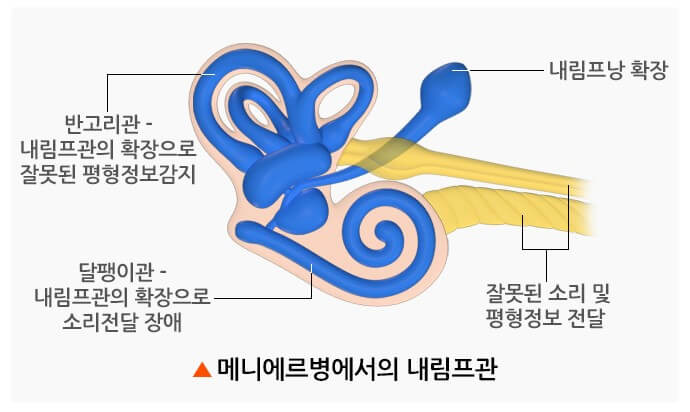 세상이 먹먹하고 소용돌이 치는 기분: 메니에르병(특발성 내림프수종) 2 ywAAAAAAQABAAACAUwAOw==