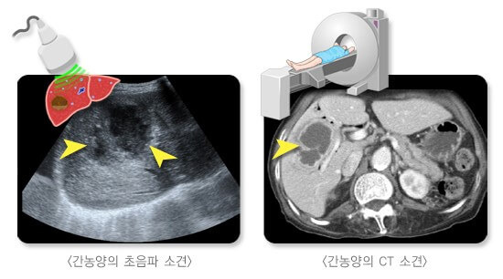 몸살인 줄 알았는데 간에 고름이 생겼어요: 간 농양 4 ywAAAAAAQABAAACAUwAOw==