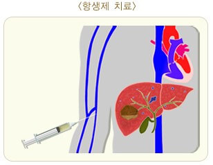 몸살인 줄 알았는데 간에 고름이 생겼어요: 간 농양 6 ywAAAAAAQABAAACAUwAOw==