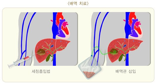 몸살인 줄 알았는데 간에 고름이 생겼어요: 간 농양 7 ywAAAAAAQABAAACAUwAOw==