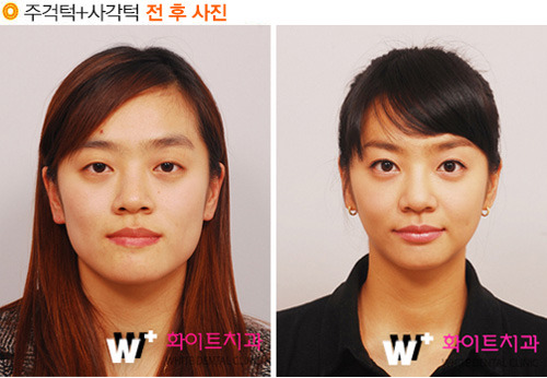 심하게 각진 턱, 양악수술로 부드럽게!