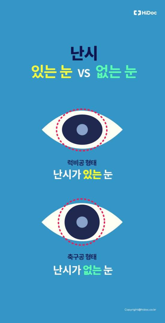 난시가 있는 눈과 없는 눈