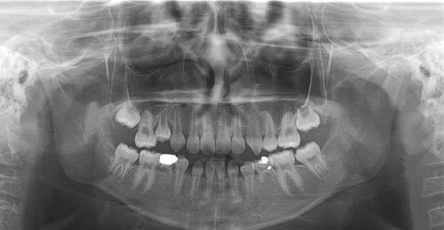 파노라마 방사선 촬영 치아 사진. 작은 어금니 4개 외 다수 치아의 선천적 결손을 확인할 수 있다. 허경회 영상치의학 교수는 시진만 할 경우 환자의 이와 같은 상태를 확인할 수 없다고 설명했다.