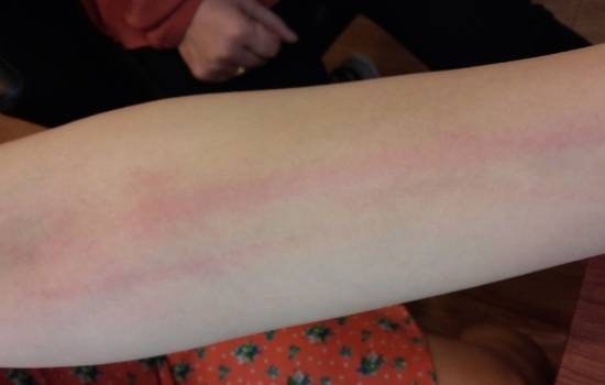 피부묘기증(청월경희한의원)