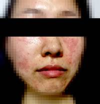 레이저 시술 후 마데카솔 도포 후 최씨(가명) 모습 / 사진=시사비즈