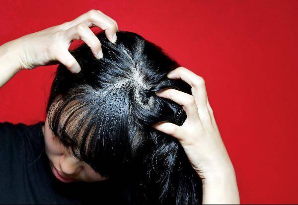 [헬스조선]두피에 지루성 피부염이 나타나면 비듬이 많이 일어나고 얼굴에 생기면 얼굴에 각질과 함께 홍반이 생겨 심한 가려움을 느끼게 된다/사진=조선일보 DB