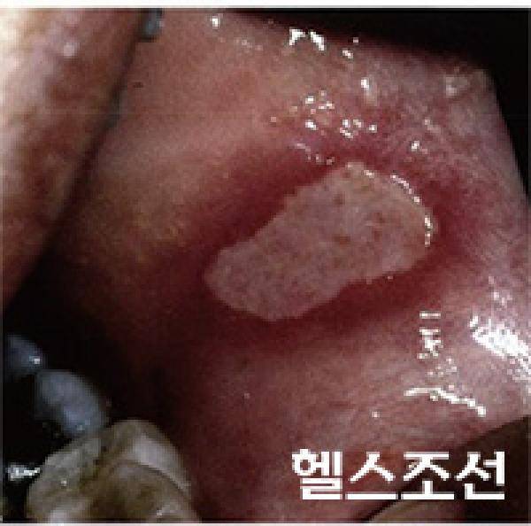 [헬스조선]