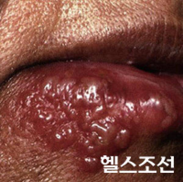 [헬스조선]