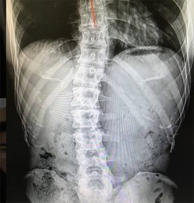 김종국이 4일 인스타그램에 공개한 본인의 척추 사진. [사진 인스타그램 캡처]