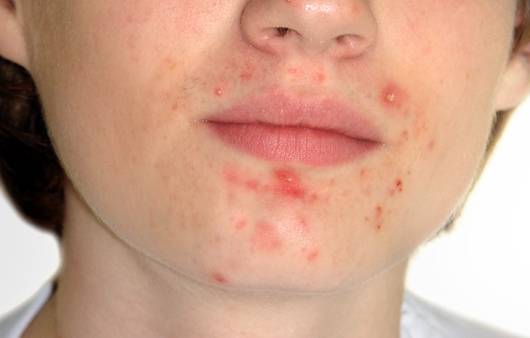 여드름이 난 얼굴