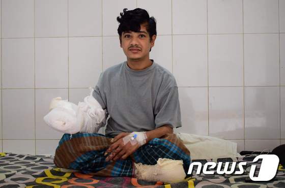 지난 4일(현지시간) 1년간 16차례의 수술을 마치고 두 손을 쓸 수 있게 된 방그라데시의 아불 바한다르(27). 그는 피부가 사마귀로 뒤덮이는 희귀 질병을 앓고 있었으나 정부 지원으로 수술을 받게 됐다. © AFP=뉴스1