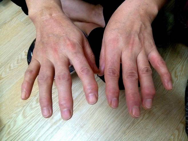 계속된 학교 급식 노동으로 변형이 생긴 손가락 관절 모습. 전국학교비정규직노조 강원지부