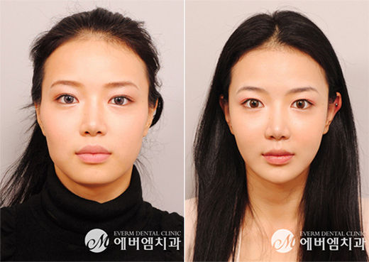 양악수술 전문의가 전하는 '긴얼굴' 측정 방법