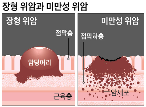 장형 위암과 미만성 위암​/사진=조선일보 DB