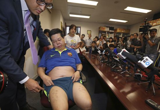 홍콩 민주당의 하워드 람 당원이 11일 홍콩의 기자회견실에서 다리에 박힌 스테이플러 철심을 보여주고 있다. AP뉴시스
