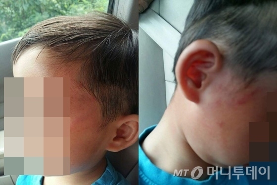 폭행 피해를 당한 어린이의 얼굴에 난 상처 /사진=피해자 측 제공