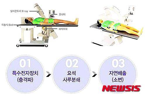 [알아봅시다]요로결석 수술 없이?..'체외충격파쇄석술'