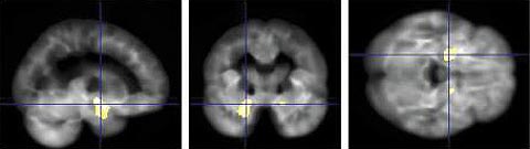 알츠하이머 환자의 뇌 MRI 영상. 인공지능은 신경세포가 모여 있는 회색질이 특정 영역(노란색)에서 크게 줄어든 것을 감지해냈다. /이탈리아 바리대