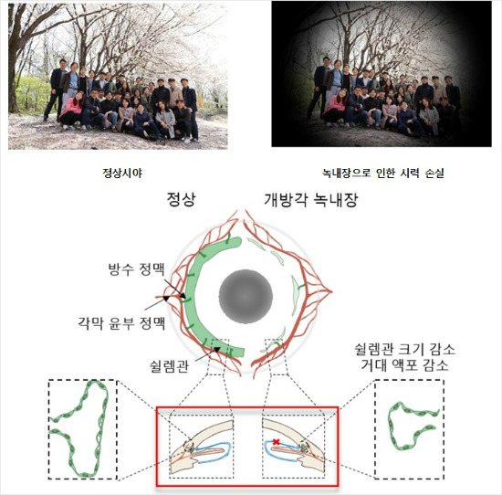 녹내장 증상과 원인.(사진 =기초과학연구원 제공)