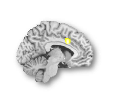 "대화 집중 못 하는 '스마트폰 중독'…알고보니 뇌에 문제".뇌기능 MRI 영상에서 갈등의 탐지와 조절에 관련된 뇌 속 '배외측전전두피질'과 '전대상피질'에서 상대적으로 저하된 뇌활성화가 관측된 모습. [연구팀 제공=연합뉴스]