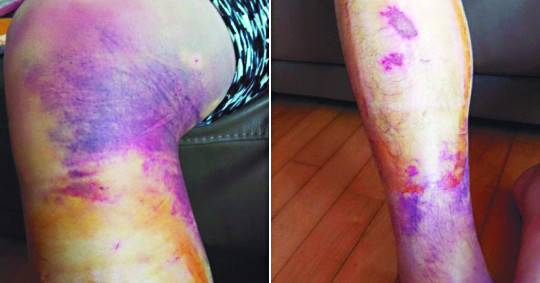 국회 교육문화체육관광위원회의 부산대병원 국감에서 더불어민주당 유은혜 의원이 공개한 사진. 지도교수의 폭행으로 전공의 다리에 피멍이 들어 있다. 유은혜 의원실 제공