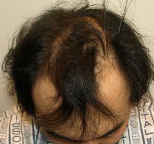 유전에 의한 탈모 사례 3. M자 부위의 탈모가 심하고 이마의 중앙 부위 모발은 정상에 가깝다.