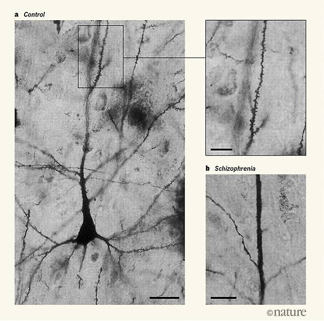 왼쪽은 건강한 뇌의 뉴런으로 위의 네모 안을 확대한 오른쪽 위 사진을 보면 검은 줄(수상돌기)의 표면에 도돌도돌 솟아난 수상돌기 가시가 보인다. 수상돌기 가시는 시냅스 수를 나타내는 지표다. 오른쪽 아래는 조현병 환자의 뉴런으로 수상돌기에 가시가 훨씬 적다. - ‘신경학 신경외과 정신의학 저널’ 제공