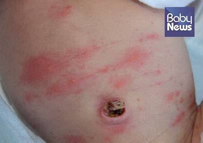 신생아 중독성 홍반(사진 1). ⓒ박준수