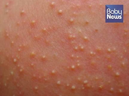 신생아 농포 멜라닌색소증(사진 2). ⓒ박준수