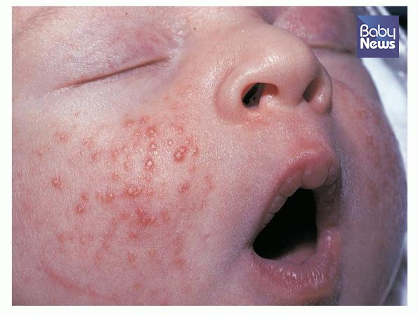 신생아 두부 농포증(사진 4). ⓒ박준수