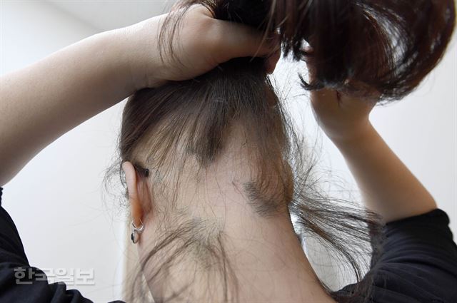 탈모 증세로 강동경희대병원을 찾은 여성 환자가 머리카락을 들어 보이고 있다. 여성에게 더욱 가혹한 외모 기준이 요구되는 한국 사회에서 여성 탈모인들이 겪는 심리적 고통은 매우 크다. 서재훈기자 spring@hankookilbo.com