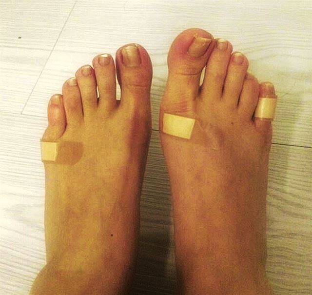 딱딱한 구두와의 마찰로 인한 통증을 줄이기 위해 발가락과 관절 등에 의료용 밴드를 붙인 판매직 노동자의 발.