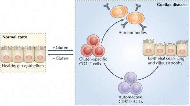 유전적 요인이 있고 소장벽을 이루는 세포 사이가 느슨할 경우 밀가루 음식을 먹으면 글루텐이 틈 사이로 투과해 자가면역반응을 일으켜 소장벽 세포를 파괴한다. 그 결과 영양결핍과 설사 등의 증상이 나타나는 게 셀리악병이다. 많은 경우 글루텐이 없는 음식을 먹으면 증상이 사라진다. - ‘네이처 리뷰 면역학’ 제공