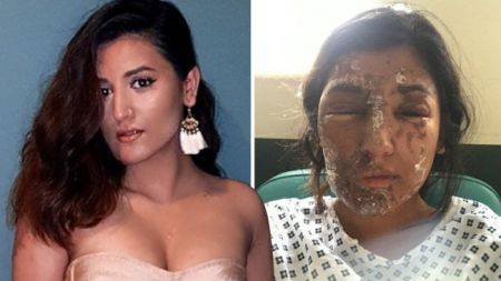 사진 왼쪽은 최근 모습, 오른쪽은 1년 전 염산테러를 당한 뒤 치료 과정의 모습