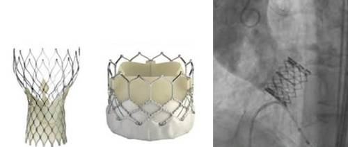 인공 대동맥 판막(좌)을 이용한 경피적 대동맥 판막 삽입술(우) [강남세브란스병원 제공=연합뉴스]