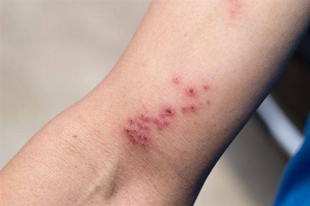 대상포진. 게티이미지뱅크