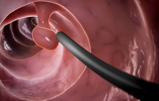 대장 용종 제거