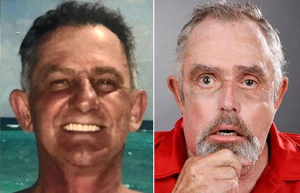 왼쪽은 사고 전, 오른쪽은 수술 후 모습